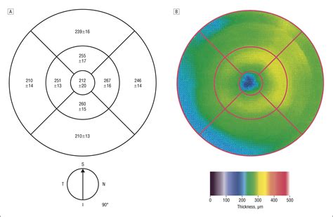 macular edema retinal thickness measurement|normal macular thickness study.